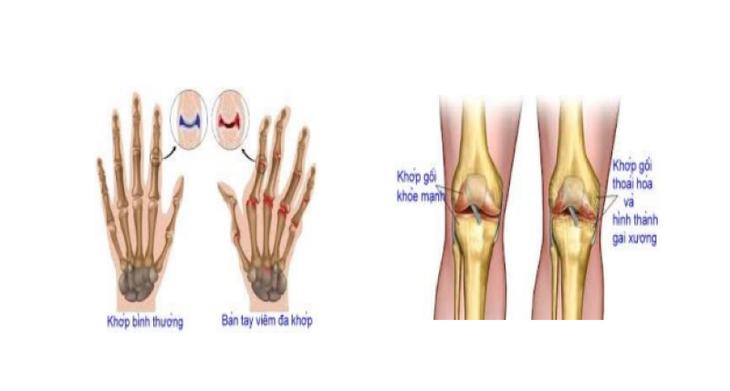 thap-khop-1-17282040184841970461146 Bấm huyệt ở tay phòng trị được viêm khớp dạng thấp - Ảnh 1.